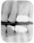 Figure 1  Preoperative radiograph of the upper left first bicuspid shows interproximal decay.
