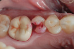 Figure 2  The tooth was prepared, after which a caries-detecting agent was applied.