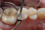 Figure 11  The final Venus Diamond composite layer was placed on the occlusal surface.