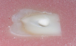 Figure 2  Dentin removal after 2 seconds with a carbide steel bur.