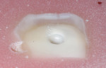Figure 3  Dentin removal after 2 seconds with a ceramic bur.