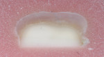 Figure 4  Dentin removal after 10 seconds with a polymer bur.