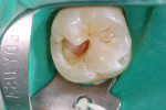Figure 9  Carious pulp exposure, maxillary first molar.