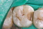 Figure 11  After preparation and caries removal.