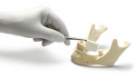 Figure 1  The new CurV regenerative product for horizontal and vertical bone augmentation.