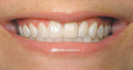 Figure 2  Close-up smile details proportions of tooth display and relative proportions to lips and symmetry bilaterally.