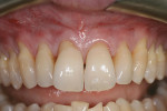 Figure 1  Preoperative view of teeth Nos. 5 through 12 shows mild to severe gingival recession.
