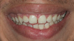 Fig 10. Clinical aspect after gingival plastic surgery and tooth bleaching.