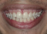 Fig 21. Close-up view of the patient’s smile at 1-year post-treatment.