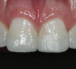 Fig 19. Buccal coverage and closure of the contact points with enamel resin.