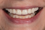 Close-up full smile photograph with teeth apart.