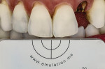 A successful single-tooth restoration, completed with Julian Cardona, CDT.