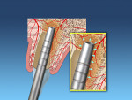 Fig 2. Osteotome used to widen the osteotomy and condense apical bone.