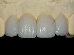 Figure 1  The all-ceramic CAD fabricated lithium-disilicate crowns were milled chairside and placed on the model to to complete esthetic layering and ensure proper fit.