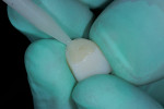 Figure 6  Multilink Automix adhesive resin cement was extruded from the automix tip and fully loaded into each lithium-disilicate anterior crown individually.