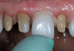 Figure 7  Crowns for teeth Nos. 7 through 10 were individually seated on the preparations and pressure was applied.