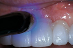 Figure 8  Using the wave technique, light-curing began across the buccal-cervical surfaces of the crowns for 3 seconds each.