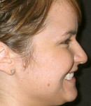 Figure 8  Profile view of full-face profile while smiling demonstrates incisal edge position and inclination relative to profile of face.