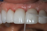 Figure 11  Dental floss was used to remove excess cement from the interproximal spaces of the lithium-disilicate crowns.