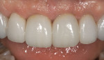Figure 14  The completed lithium-disilicate crowns after 2 weeks.