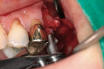 Figure 4  A carrier is used to introduce the graft material into the prepared osteotomy site.