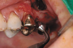 Figure 6  The condenser is used to place the graft material into the apical portion of the osteotomy and into the elevated sinus.
