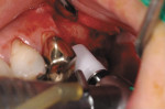 Figure 7  Implant introduced into the osteotomy after sinus elevation with the CAS-KIT.