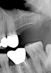 Figure 10  The preoperative radiograph demonstrates a curved root with poor restorative prognosis.