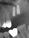 Figure 11  The postoperative radiograph after internal sinus augmentation and placement of a Hiossen HG III implant (5-mm x 13-mm size).