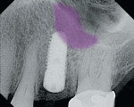 Figure 14  The highlighted area illustrates the gain in available bone after internal sinus augmentation and implant placement.
