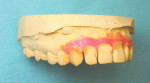 Figure 12  Right side view of modified models of teeth set in wax and separated to produce aligner to accomplish planned movement.
