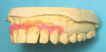 Figure 13  Left side view of modified models of teeth set in wax and separated to produce aligner to accomplish planned movement.