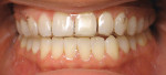 Figure 14  View of aligner in place over maxillary teeth, created on modified casts.