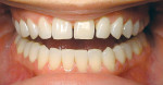 Figure 15  View of incisors spacing achieved by wearing aligner in preparation of restorative treatment.