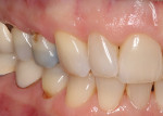 The patient presented for preparation of tooth No. 5 and a detailed, clean dental impression.