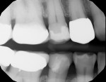 Postoperative radiograph demonstrating a healthy, restored smile line.