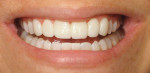 Figure 16  View of provisional veneers bonded in place closeup to communicate to ceramist dimension shape and the changes to make.