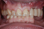 Postoperative view 3 months after esthetic crown lengthening.