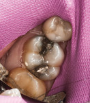 Preoperative view of tooth No. 3 with failing amalgam restoration and visible recurrent decay isolated to the mesial and distal interproximal areas.