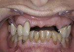 Figure 1  The patient presented with complaints of pain in the maxillary arch and an existing cast partial denture with many broken clasps.