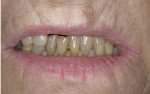 Figure 3  Although the reposed smile photograph showed the patient’s shrunken and unsupported upper lip, the lower anterior dentition appeared in good condition.