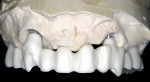 Figure 9  After milling, the zirconia implant bridge was placed on the model to verify fit and prepare for ceramic layering.