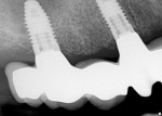 Figure 13  A radiograph was used to ensure the zirconia implant bridge fit the maxillary right implants.