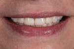 Fig 10. Close-up full smile photograph.