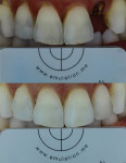 Fig 22. This successful single-tooth restoration is completed with Julian Cardona, CDT.