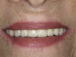 Figure 16  The zirconia implant bridge vastly improved the esthetics of the patient’s smile.