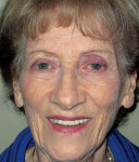 Figure 17  Eight months after treatment, the patient remained pleased with the function, fit, form, and esthetics of her restoration.