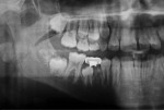 Radiograph taken 4 years and 8 months after treatment.