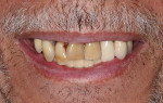 The patient presented with periodontally involved nonrestorable maxillary teeth.