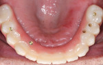 The final zirconia prosthesis was milled to the specifications captured by the transitional appliance. Note that the access holes are on the palatal surface of the appliance.
